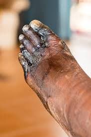 Komplikasi kaki diabetes - luka yang tidak sembuh